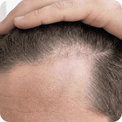 M字ヘアライン片側 (5cm × 5cm) 