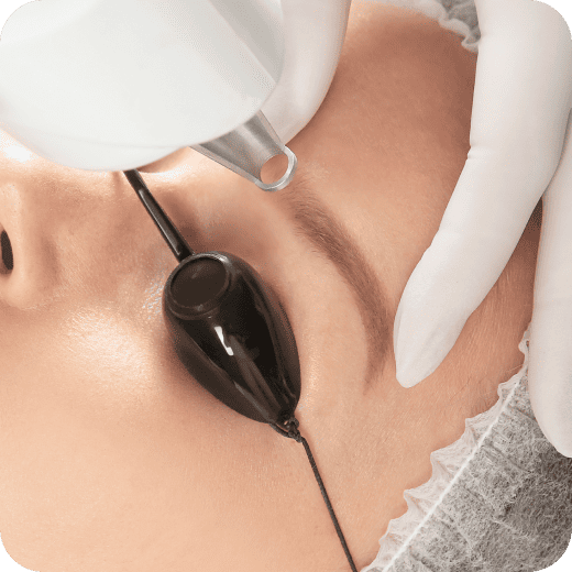 アートメイク除去レーザー